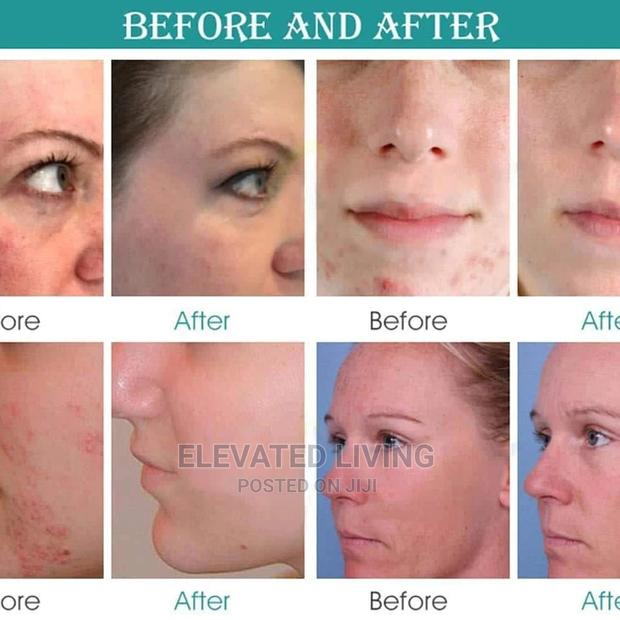 Say Goodbye to Acne and Wrinkles. - thumbnail 4