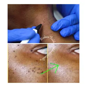 Warts/Tags