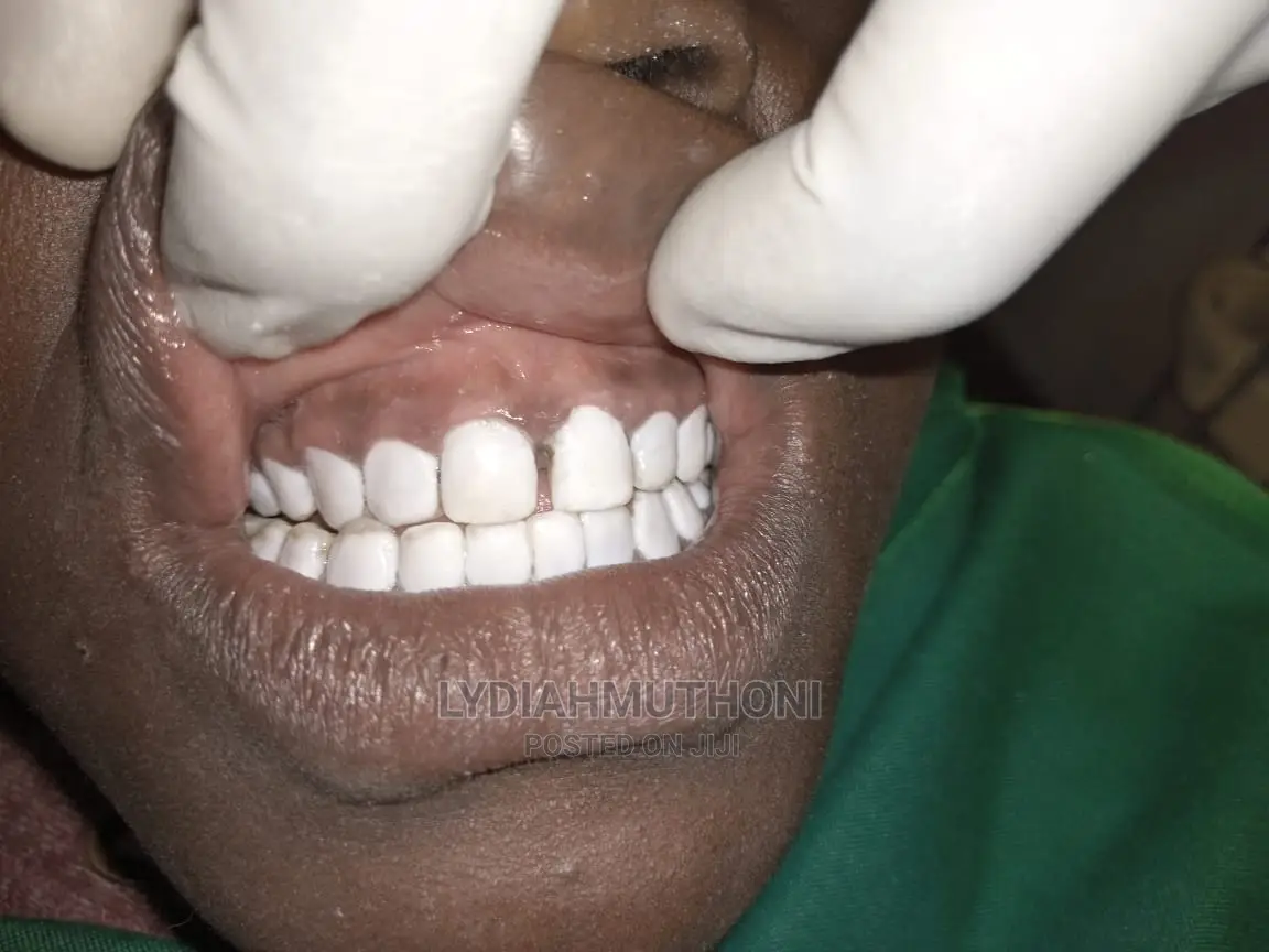 Teeth Whitening/Masking in Utawala Health & Beauty Services