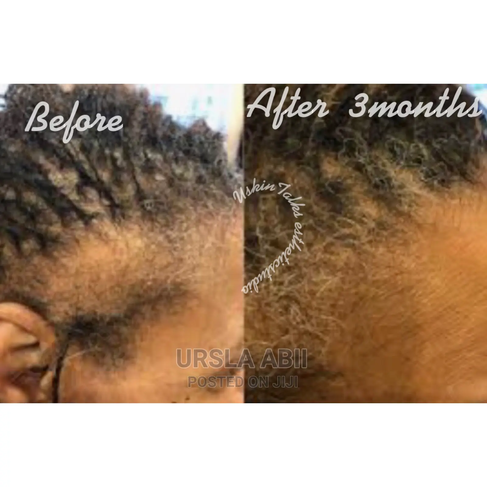 Hair Lose/Thinning Hair/Baldness