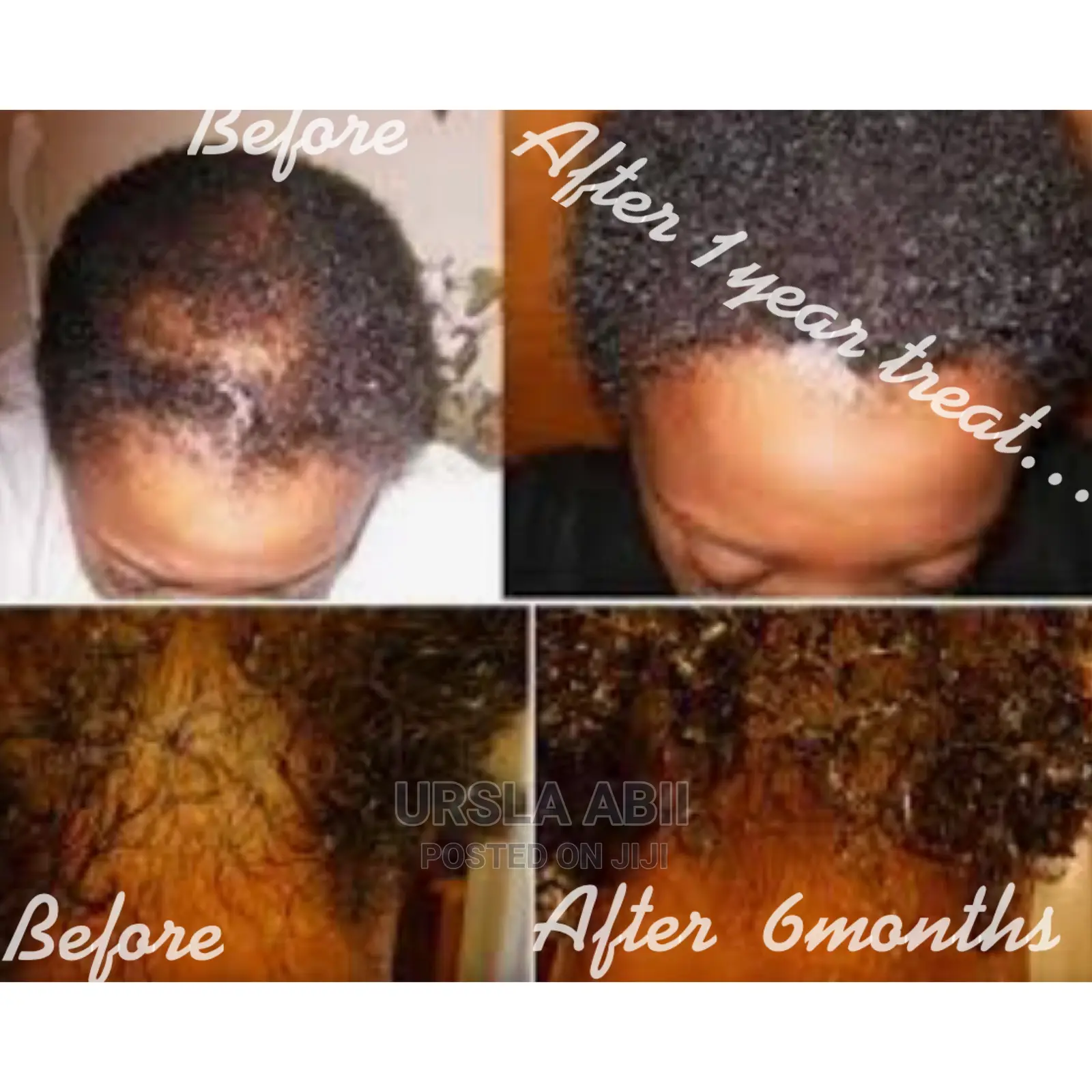 Hair Lose/Thinning Hair/Baldness