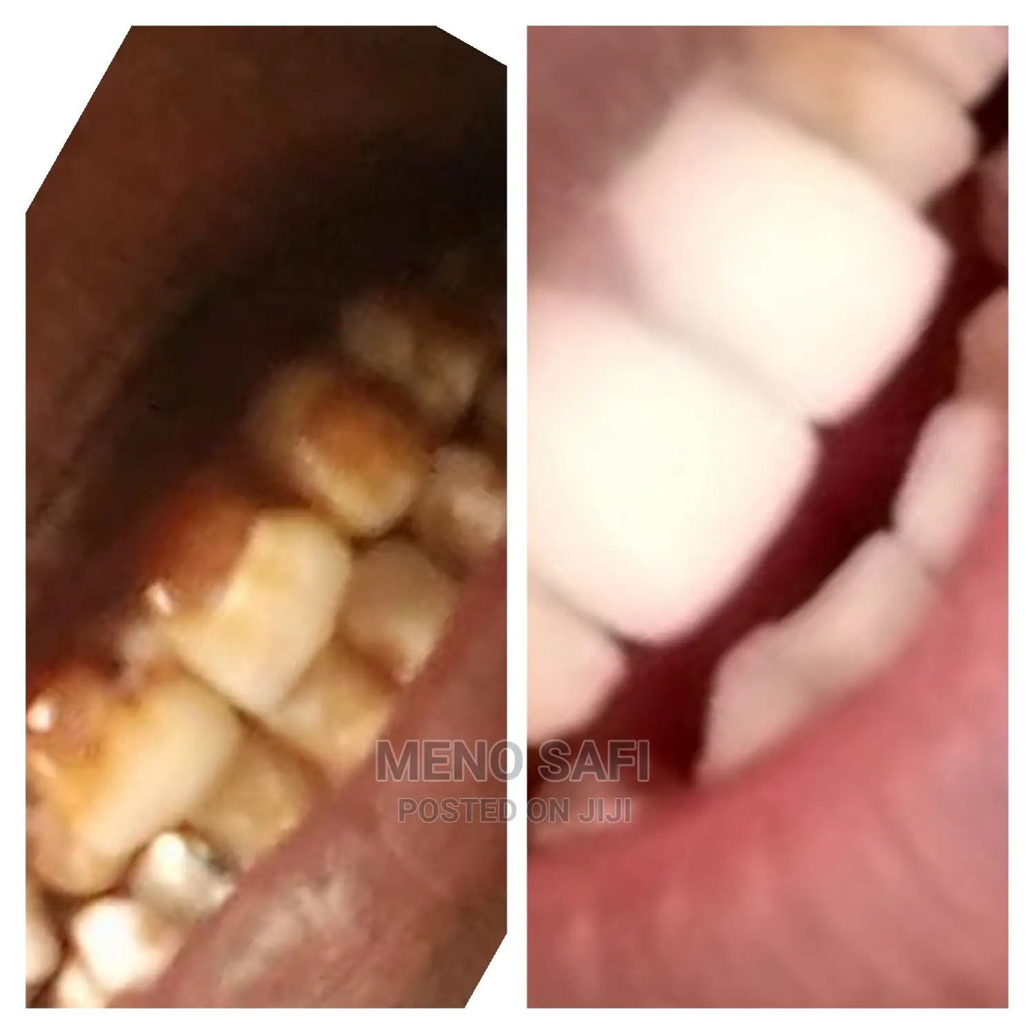 Teeth Cleaning and Oral Health