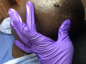 Hair Lose/Thinning Hair/Baldness