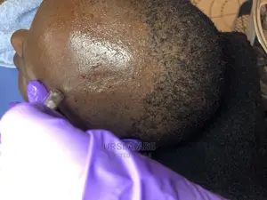 Hair Lose/Thinning Hair/Baldness