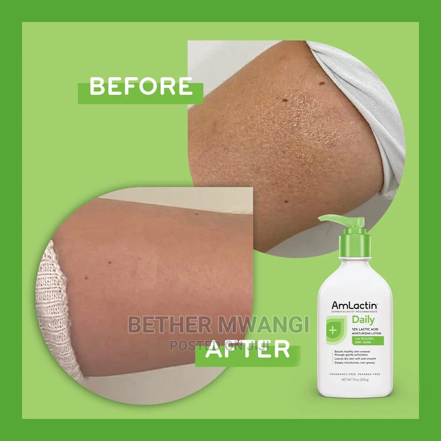 Amlactin Daily Moisturizing Lotion