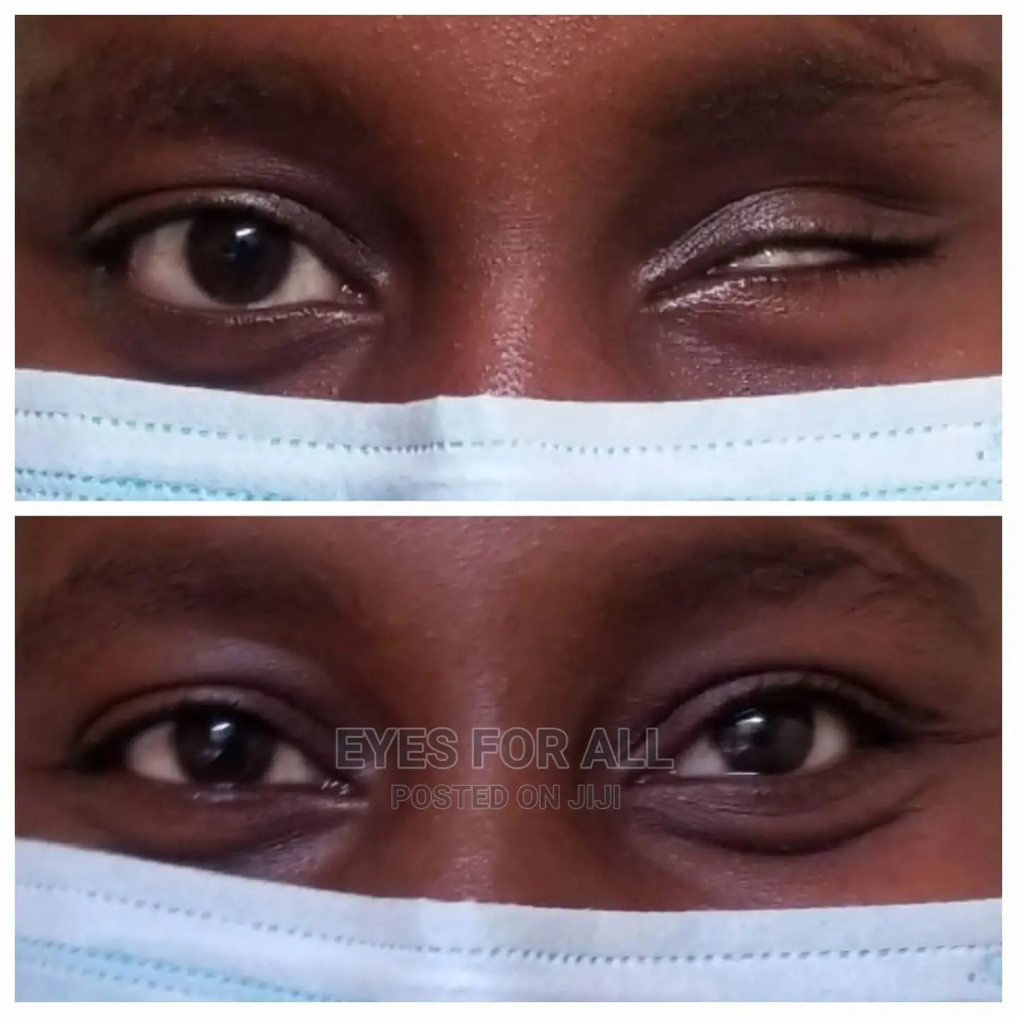 Custom Artificial Prosthetic Eyes Nairobi in Lavington Health