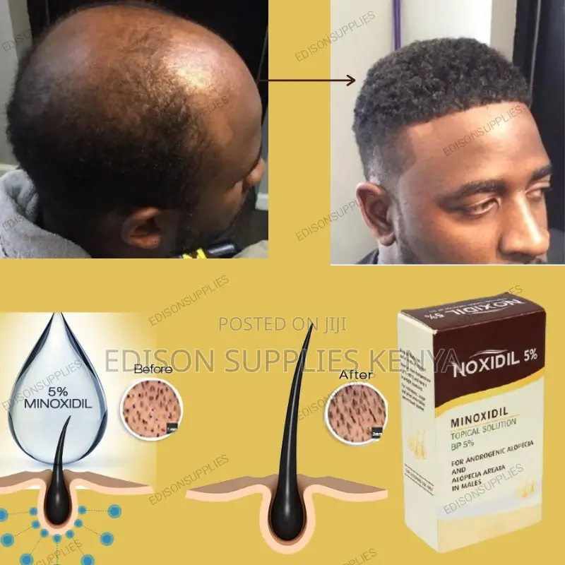 Minoxidil Noxidil 5% Human Hair Growth -Balding Grows Hair