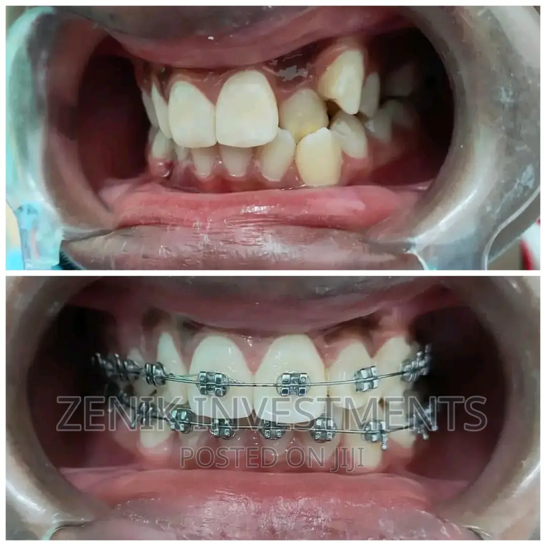 Teeth Alignment With Braces in Nakuru in Rongai Health & Beauty