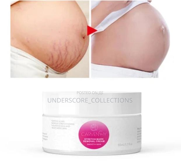 Removal Cream, Helps in Sturborn Stretch Marks and Scars