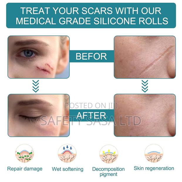 Medical Grade Silicone Scar Sheets - thumbnail 3