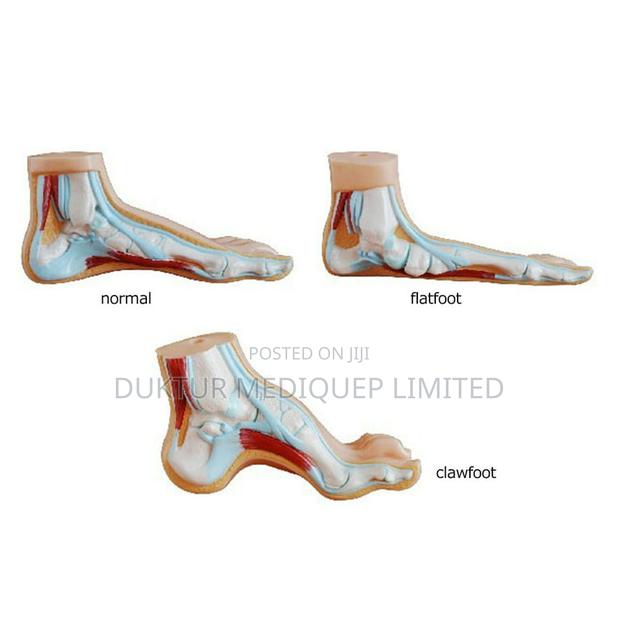 1 Pair Flat Feet Orthotic Arch Support - thumbnail 2