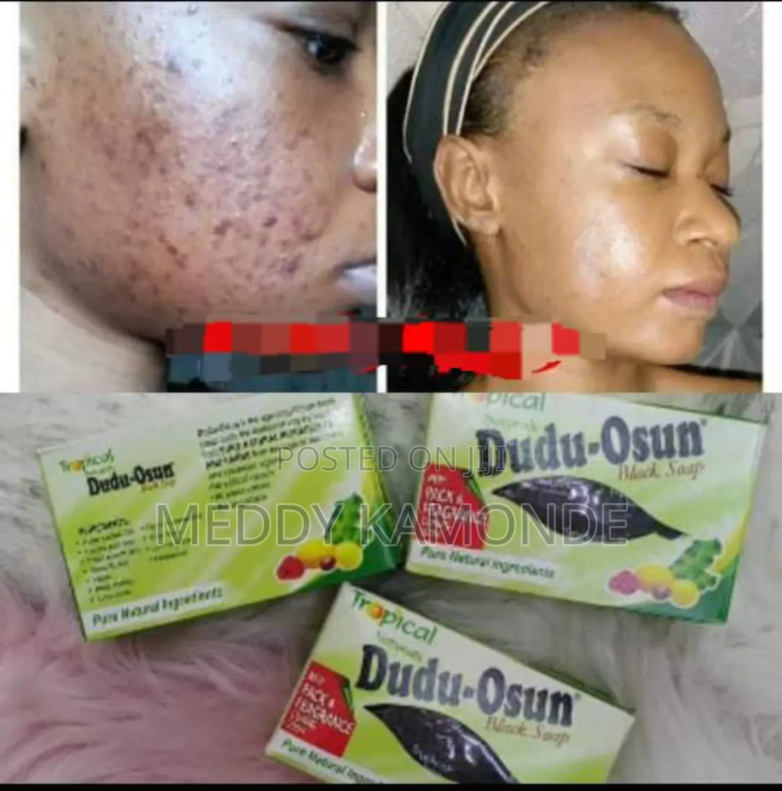 Pimple Remover Soaps/Acne Soaps