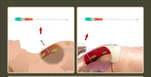 Phneomthorax Chest Decompression Kit/ Needle G14 - main view