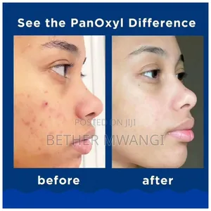 Panoxyl Acne Foaming Wash