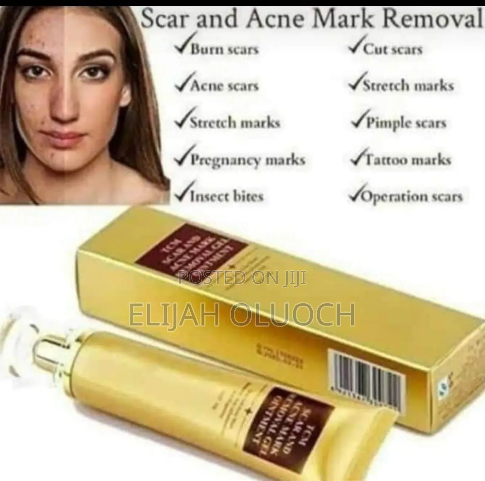 Scar and Acne Mark Removal