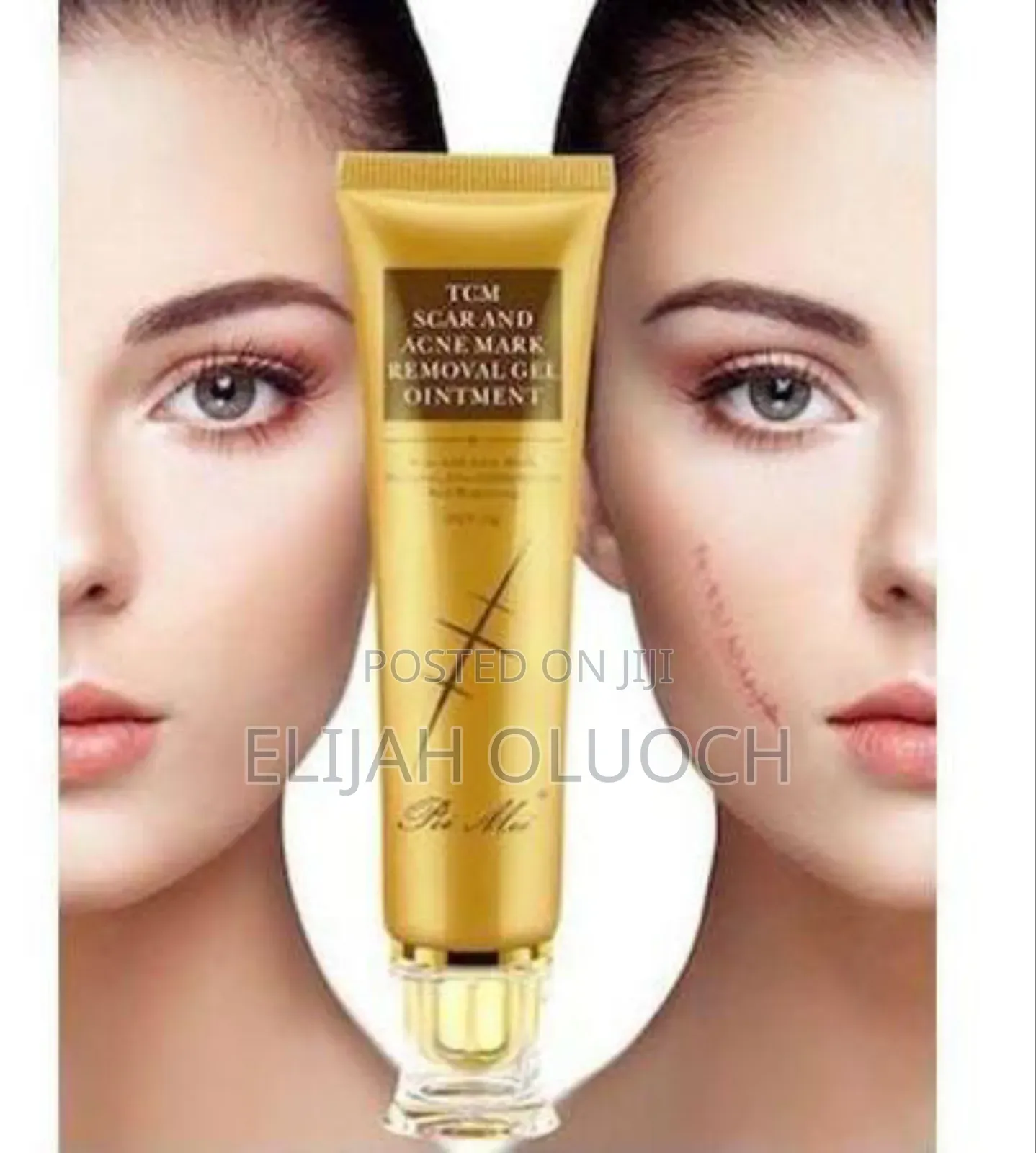 Scar and Acne Mark Removal