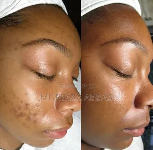 Garnier Pure Active Acne Removing Scrub