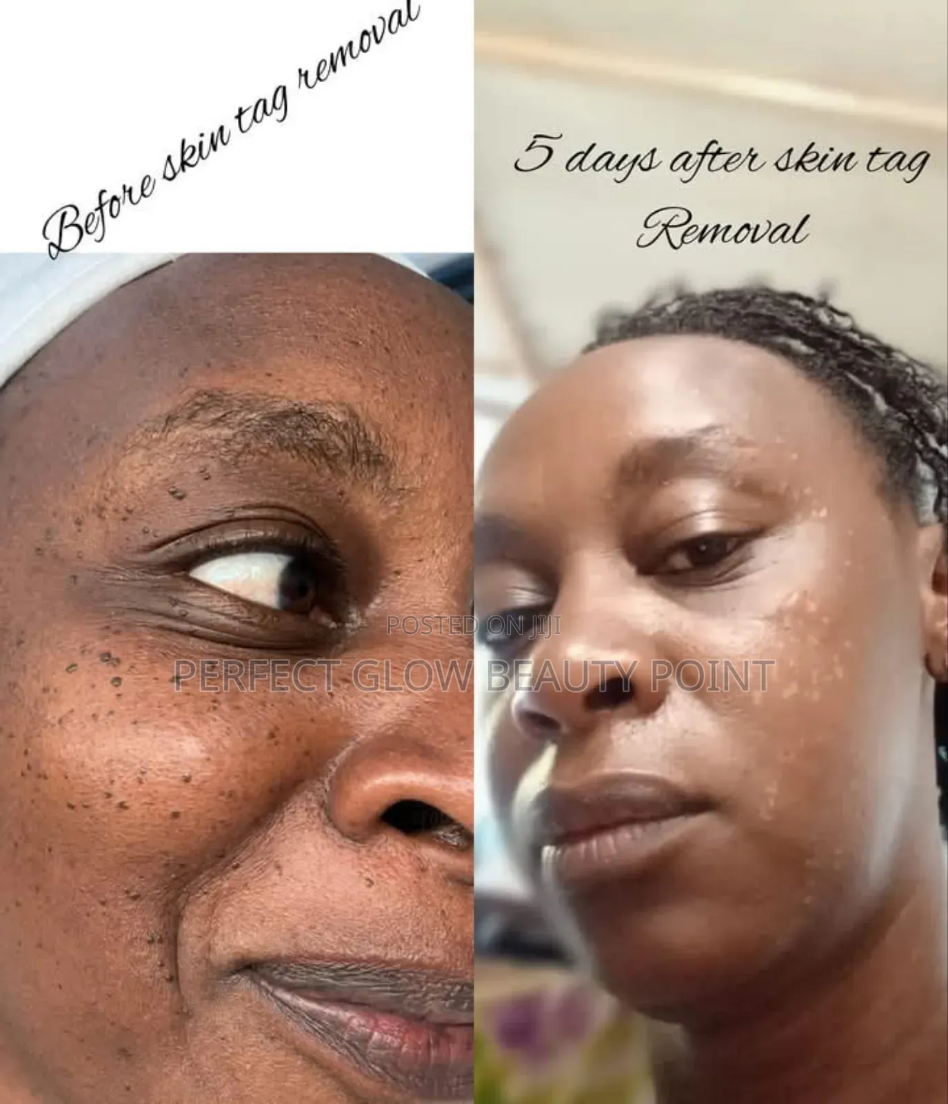 Skin Tag Removal