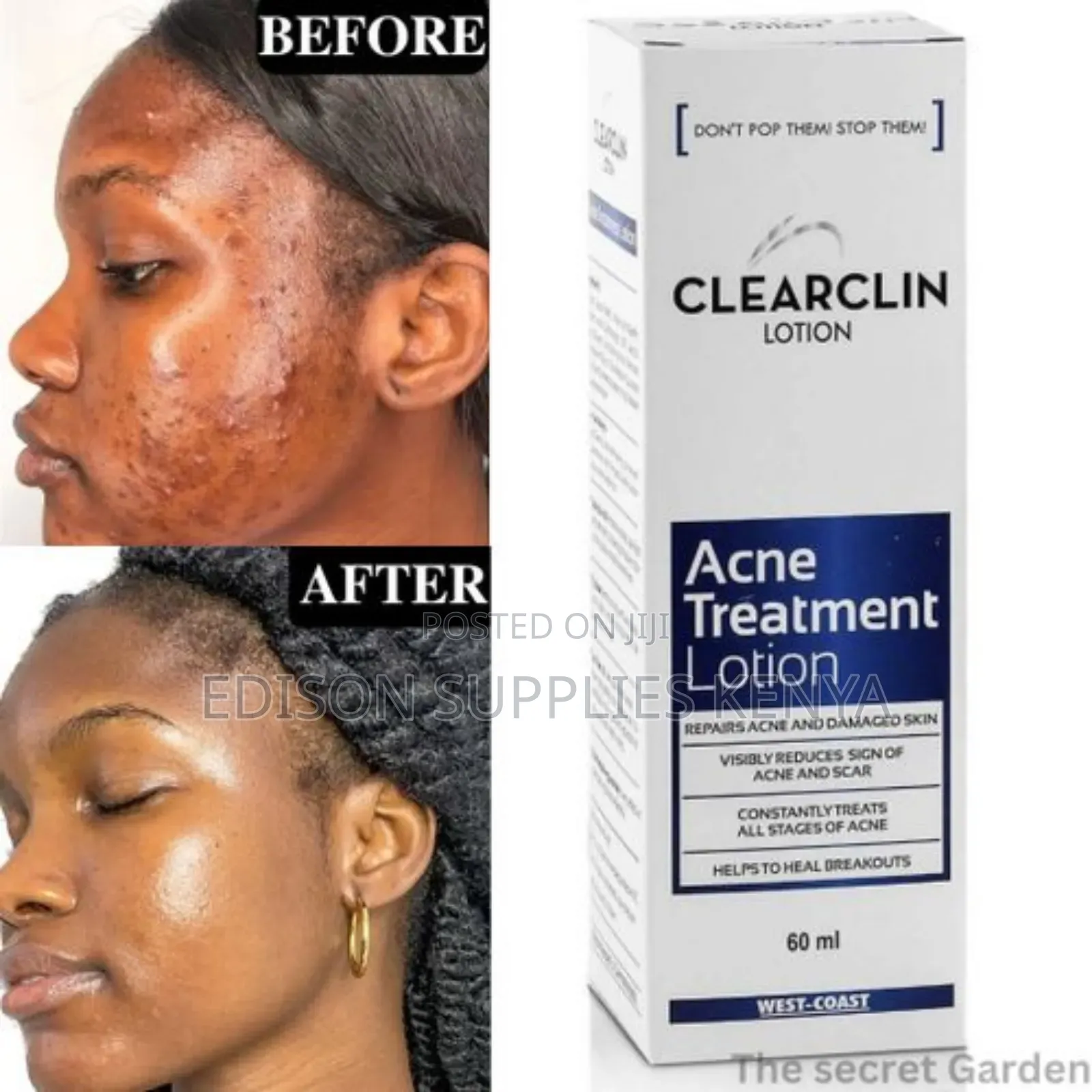 Clearclin Acne Treatment Lotion for Pimples and Dark Spots