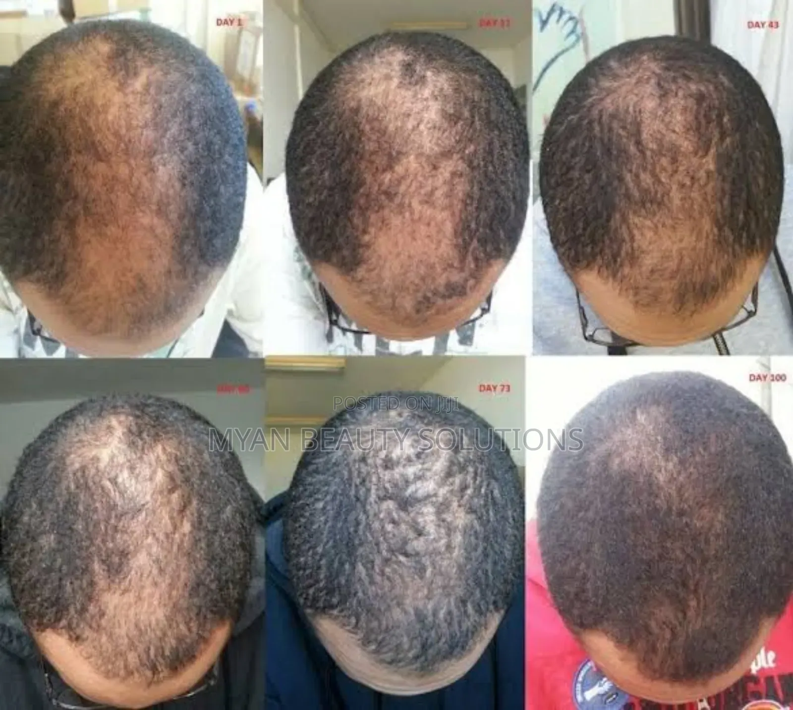 Minoxidil Topical Solution