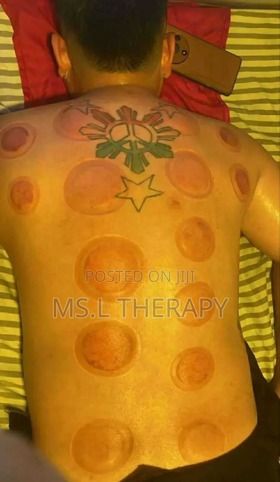 Vacuum Cupping And Hijama Treatment