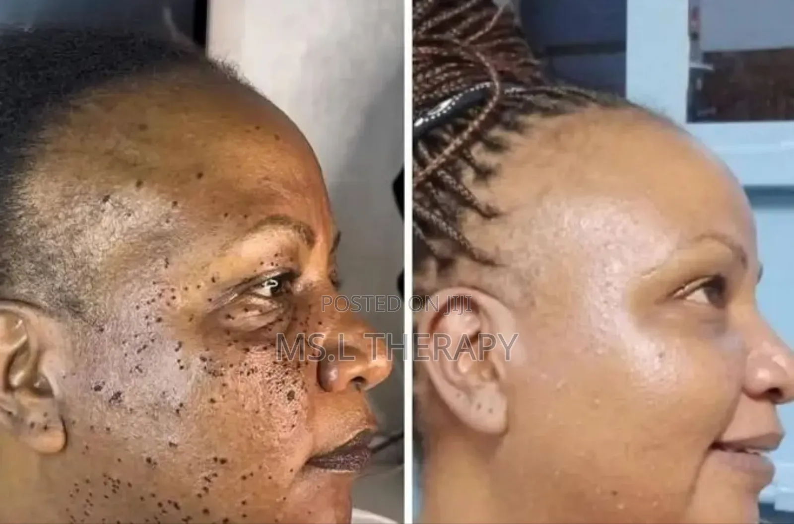 Skin Tag Removal and Facial Treatment Services