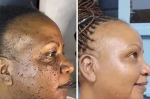 Skin Tag Removal and Facial Treatment Services