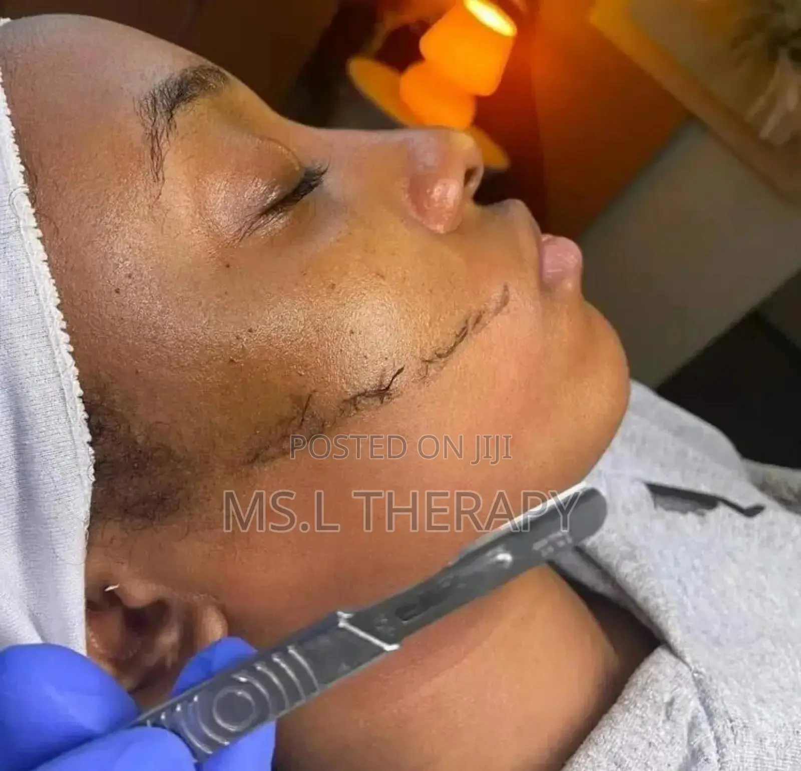 Skin Tag Removal and Facial Treatment Services