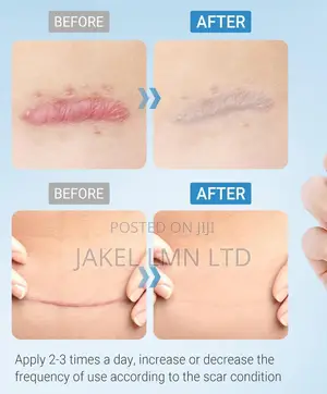 Kelo Cote Silicone Scar Gel Treatment- 15g