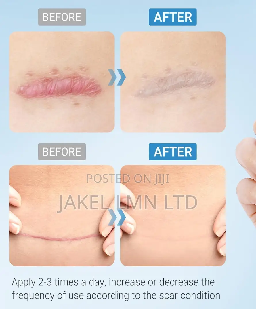 Kelo Cote Silicone Scar Gel Treatment- 15g