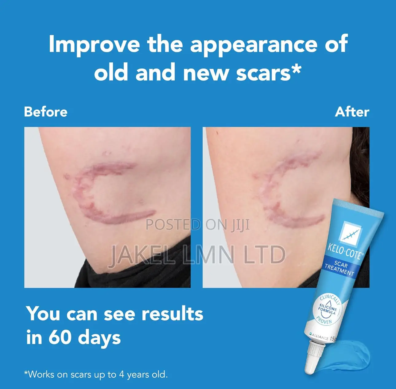 Kelo Cote Silicone Scar Gel Treatment- 15g