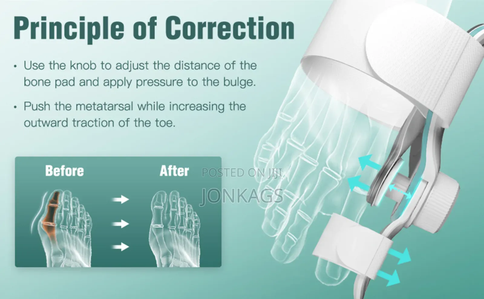 Adjustable Bunion Corrector