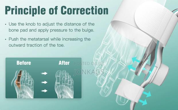 Adjustable Bunion Corrector - thumbnail 3