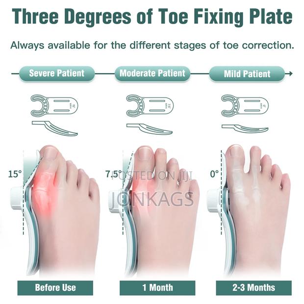 Adjustable Bunion Corrector - thumbnail 7
