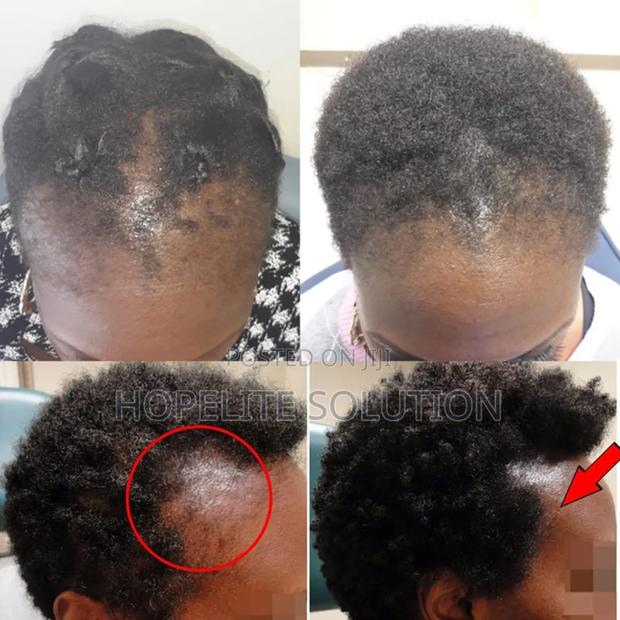 Hair Growth Spray,Ant Hair Loss - thumbnail 2