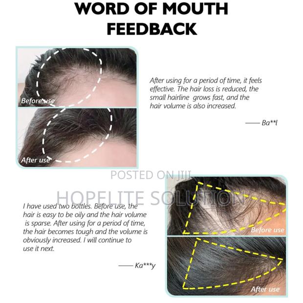 Hair Growth Spray,Ant Hair Loss - thumbnail 3