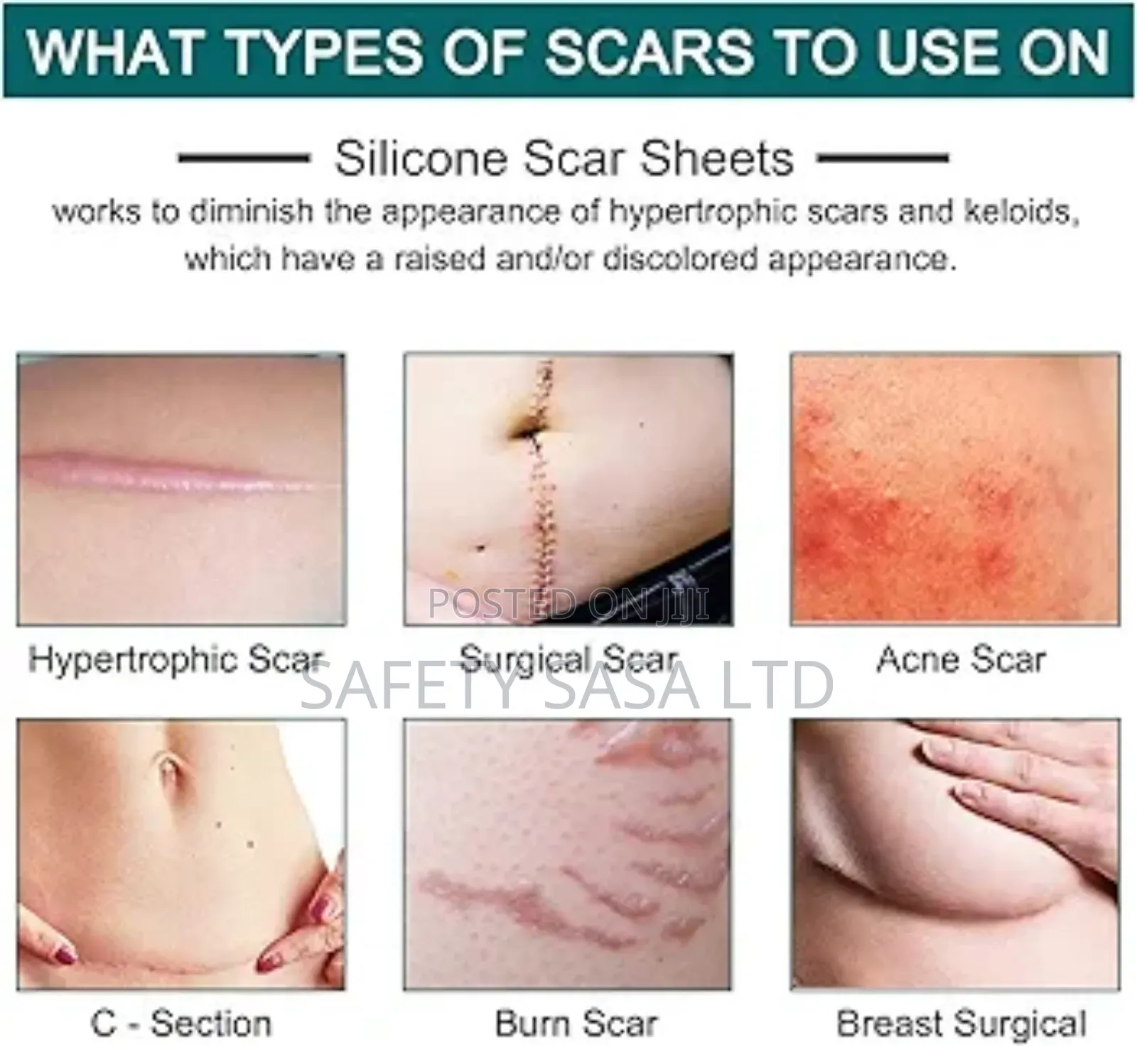 Silicone Scar Sheet