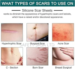 Silicone Scar Sheet