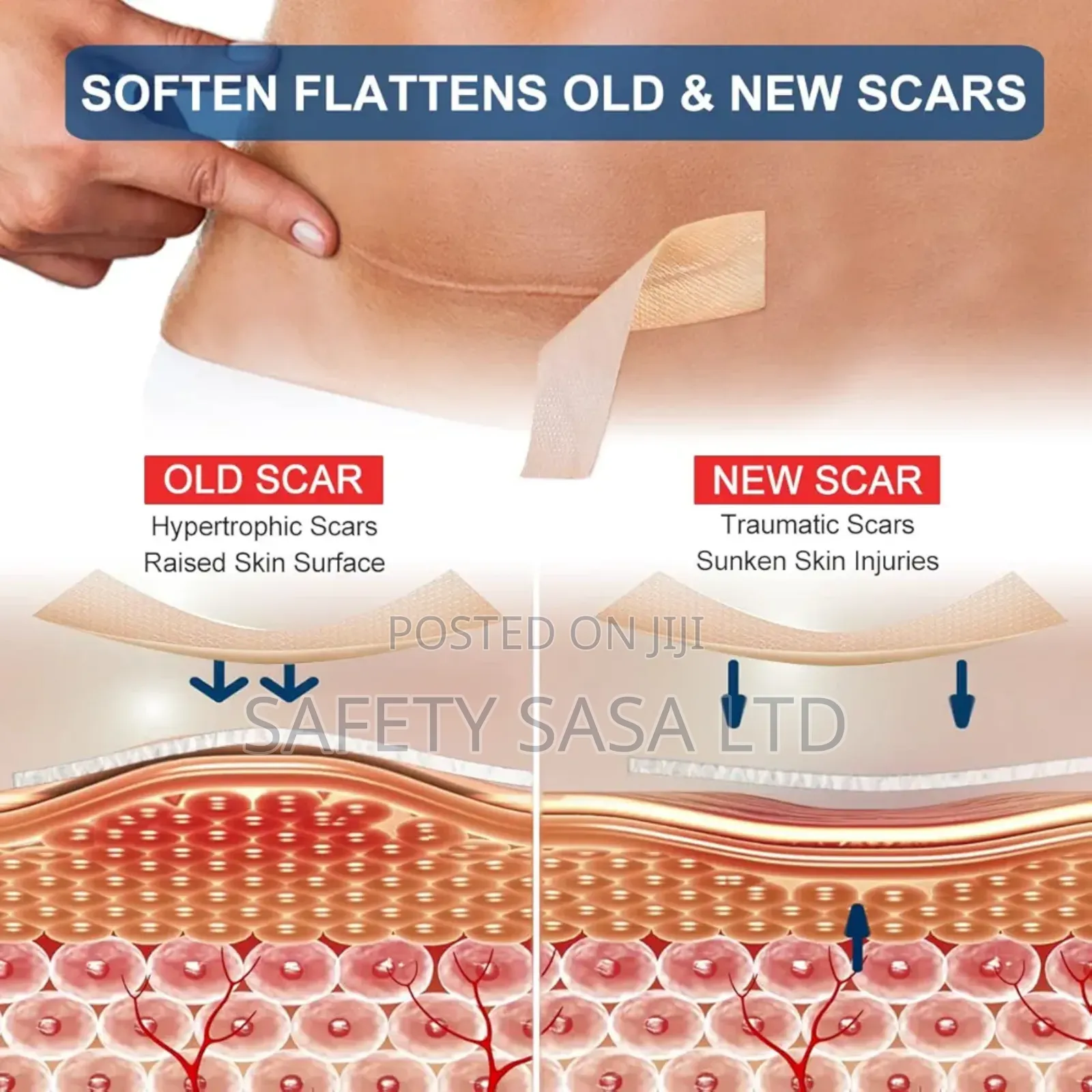 Silicone Scar Sheet