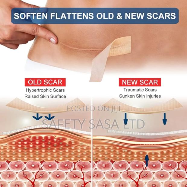 Silicone Scar Sheet - thumbnail 3