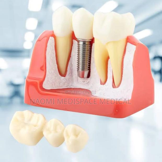 Giant Dental Implant Model - main view