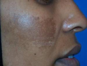 Melasmas Therapy Cream - thumbnail 2