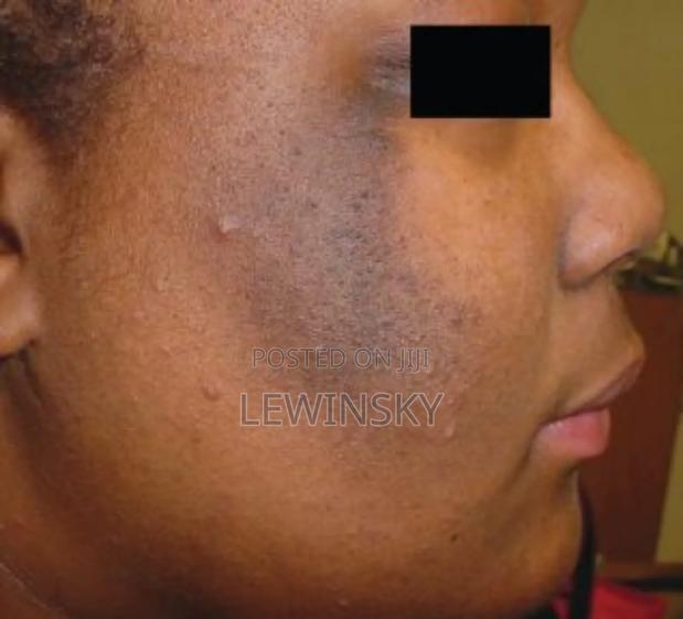 Melasmas Therapy Cream - thumbnail 3