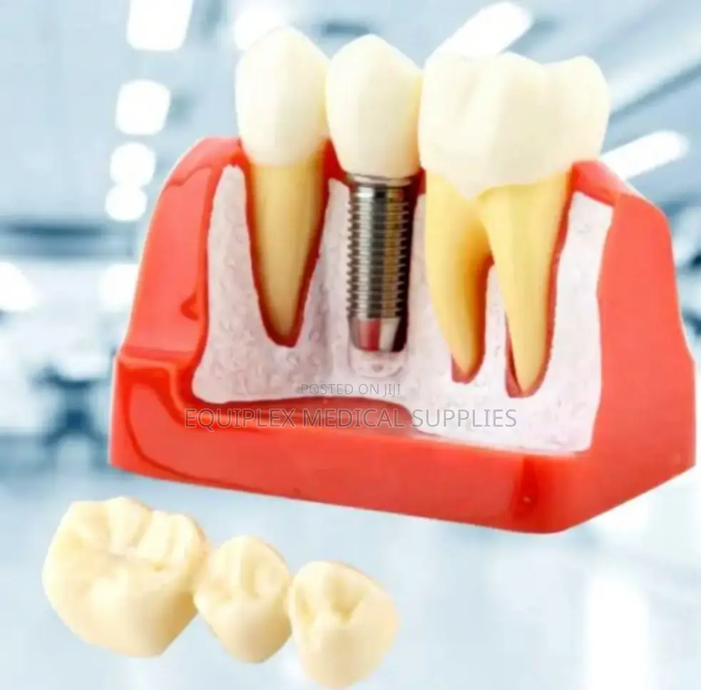 Giant Dental Implant Model