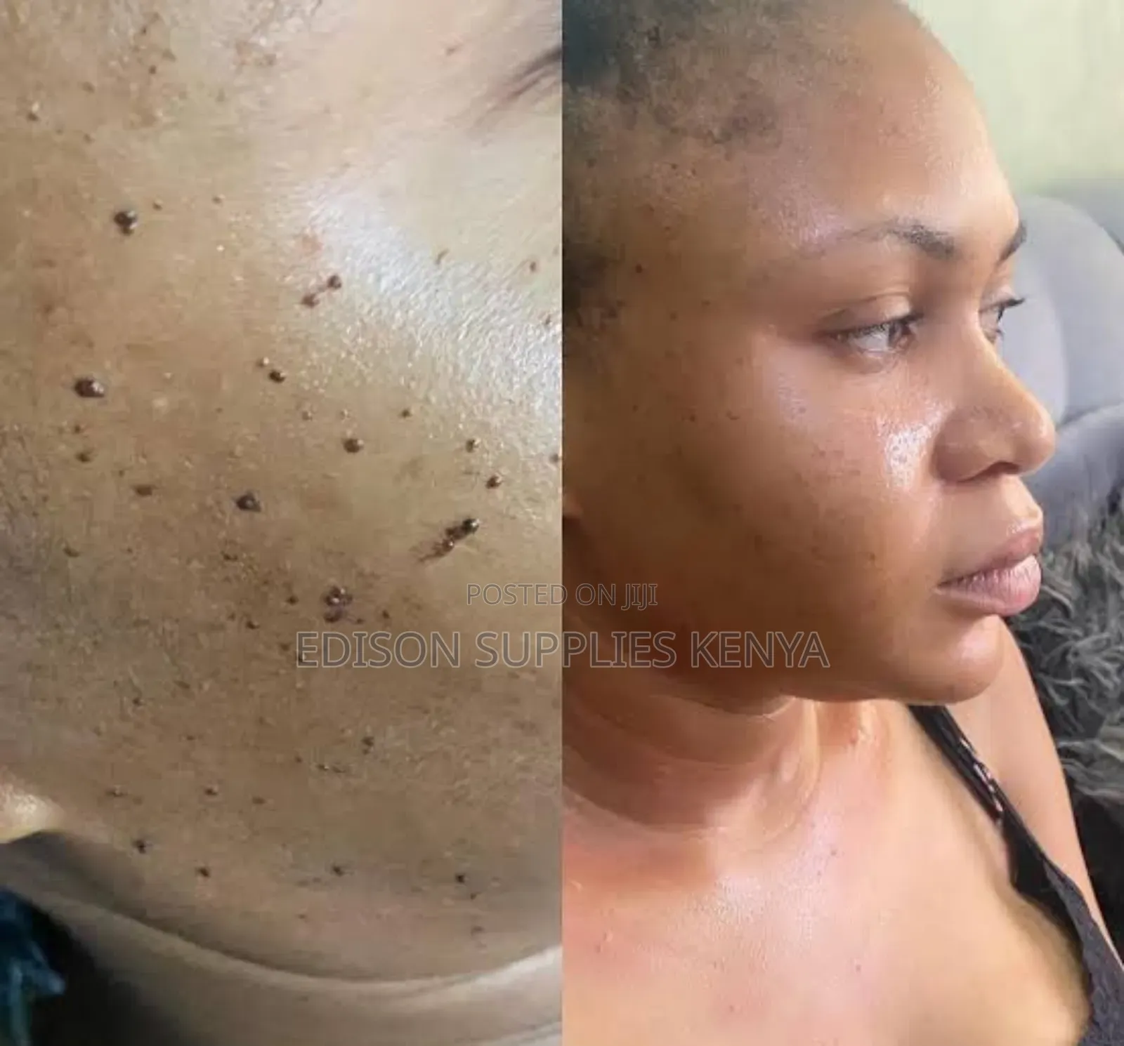 Professional Skin Tags Mole Removal Pen Diy Skin Tags Removal at Home