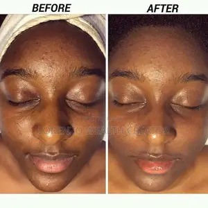 Acne Treatment That Removes Facial Blemishes