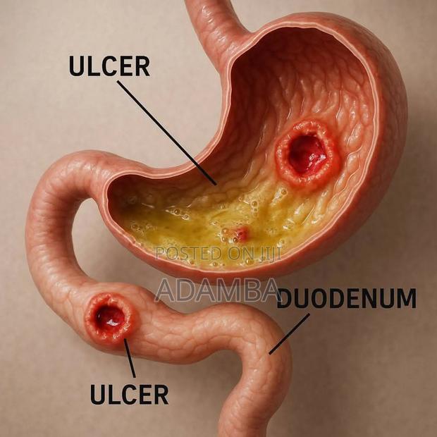 Ulcer Treatment - thumbnail 2
