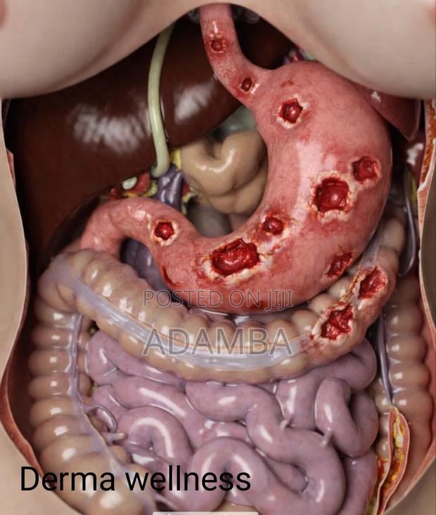 Ulcer Treatment - thumbnail 3