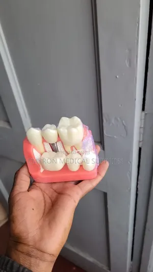 Implant Model
