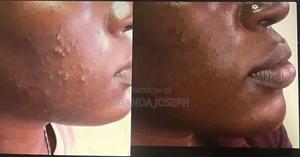 Get Rid Of Acne And Pimples In 7days - thumbnail 2